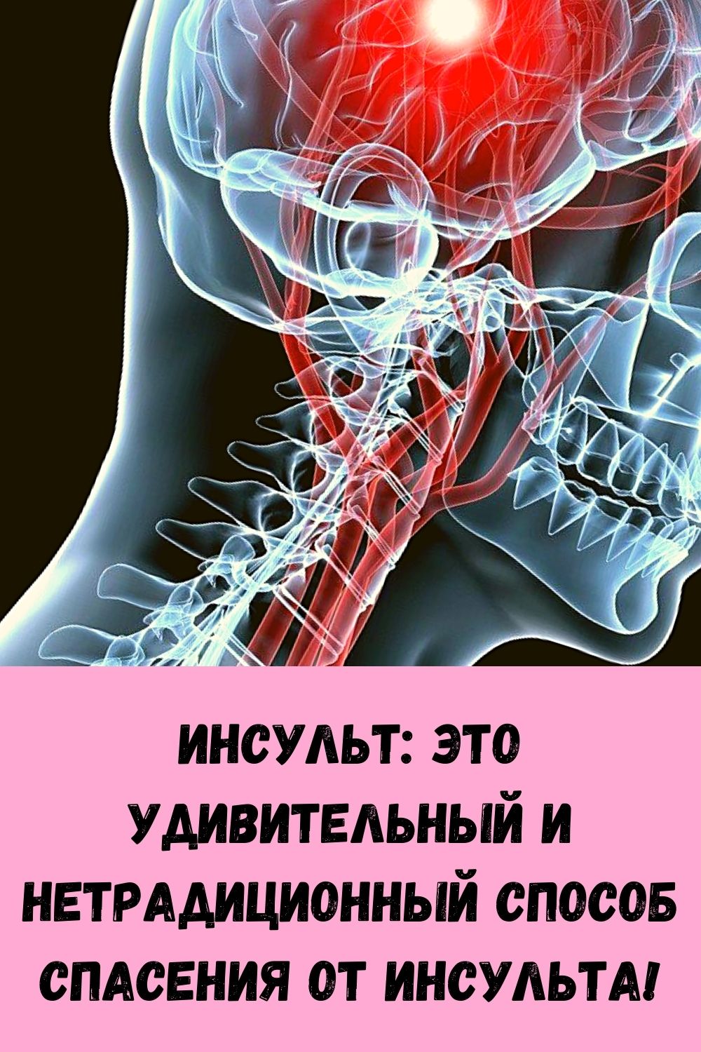 Инсульт это. Инсульт. Гемореологический ишемический инсульт.