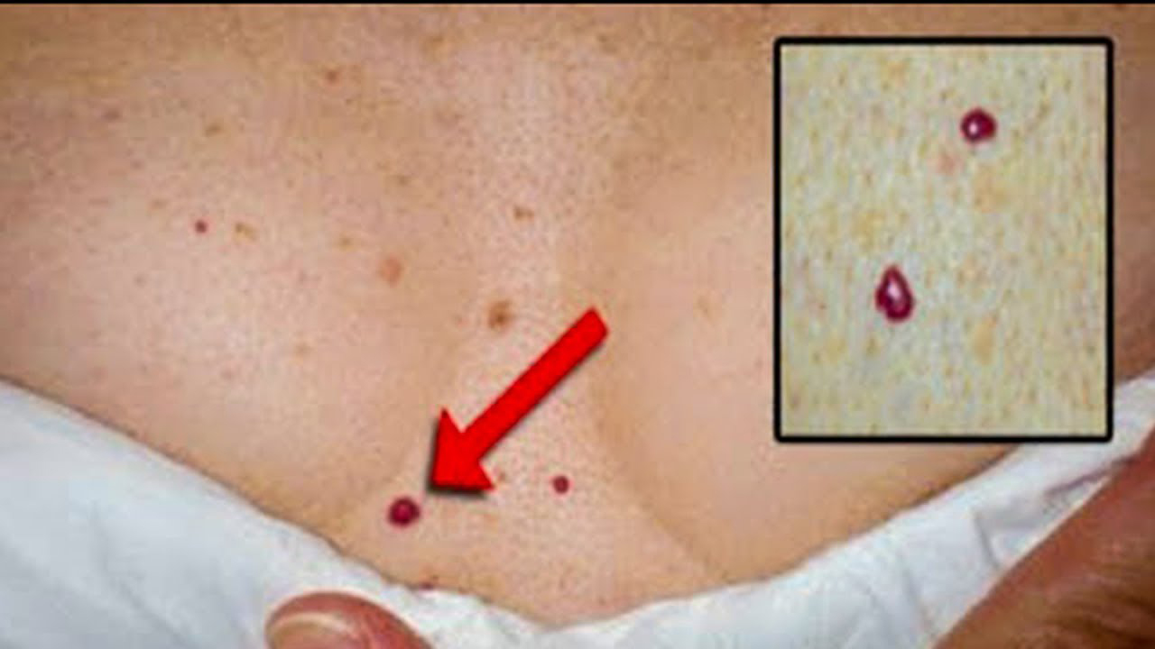 У вас есть красные точки на теле? Знайте - это симптом Тужилина!