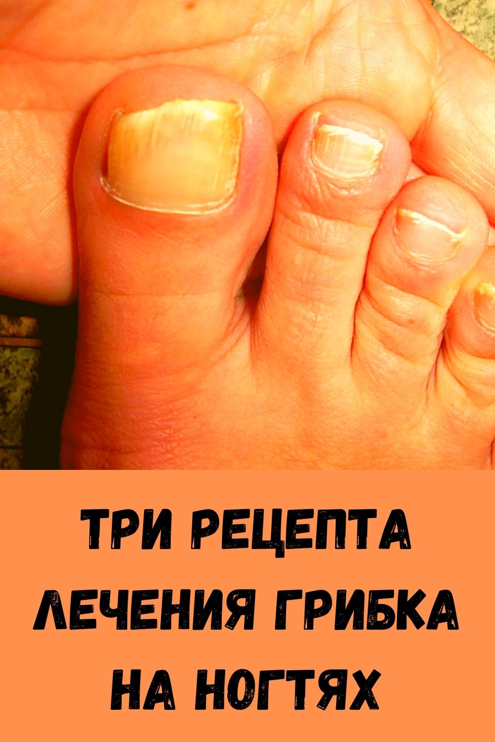 ТРИ РЕЦЕПТА ЛЕЧЕНИЯ ГРИБКА НА НОГТЯХ - womenres.ru