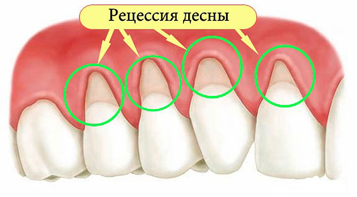 Как устранить оголение шейки зуба и не допустить потерю зубов? Помогут .